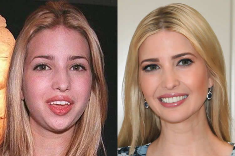 Ivanka Trump had plastic surgery just to please her father